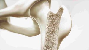 هشاشة العظام 300x169