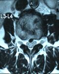 13 6 09spine fixation