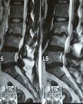 13 6 09spine fixation