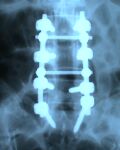 13 6 09spine fixation1