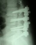 13 6 09spine fixation2