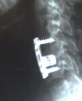 31 3 09spine fixation.bmp