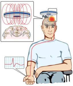 Transcranial magnetic stimulation excites a network of neurons in the underlying motor 1 254x300
