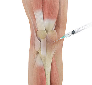 Cortisone injection
