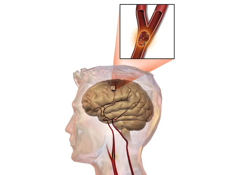 ICTUS