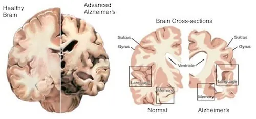 Alzheimer hastalığı tedavisinde uygulanan TMS tedavisi