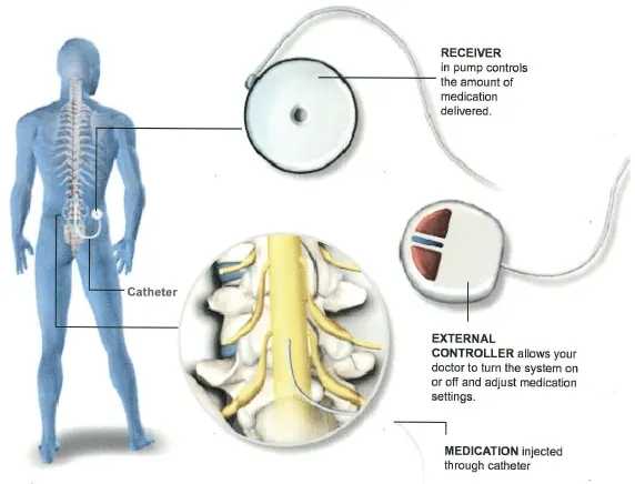 Diagram of an intrathecal pump implanted under the skin, with a catheter running into the spinal canal