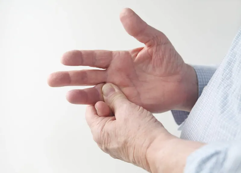 Hand affected by complex regional pain syndrome
