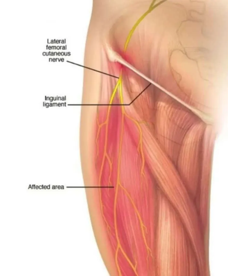 Lateral femoral kutanöz sinirin pelvis ve uyluk boyunca seyrini gösteren diyagram
